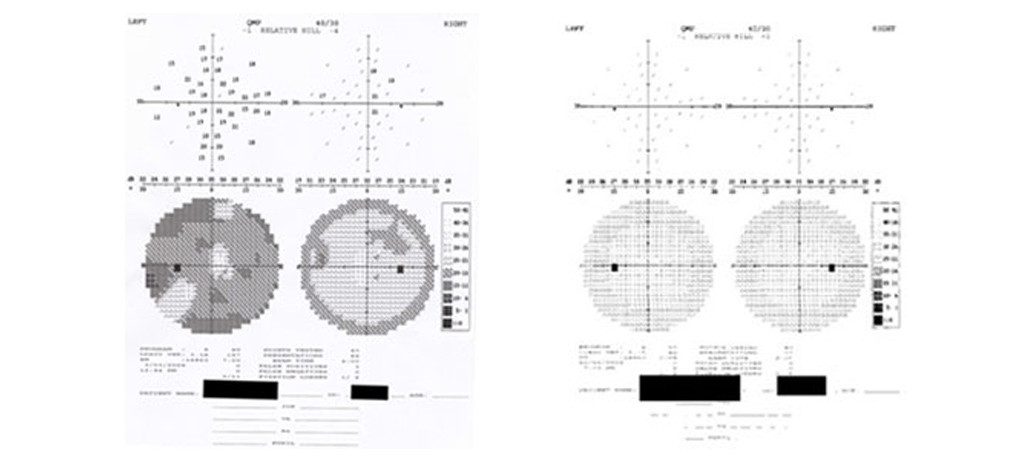 Field screening checks your peripheral vision