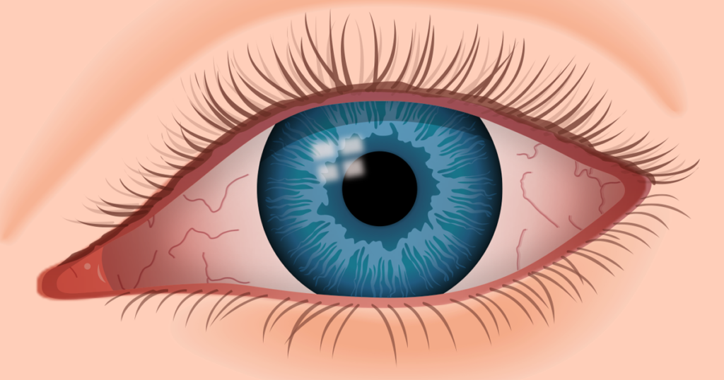 Are You Suffering With Dry Eyes?
